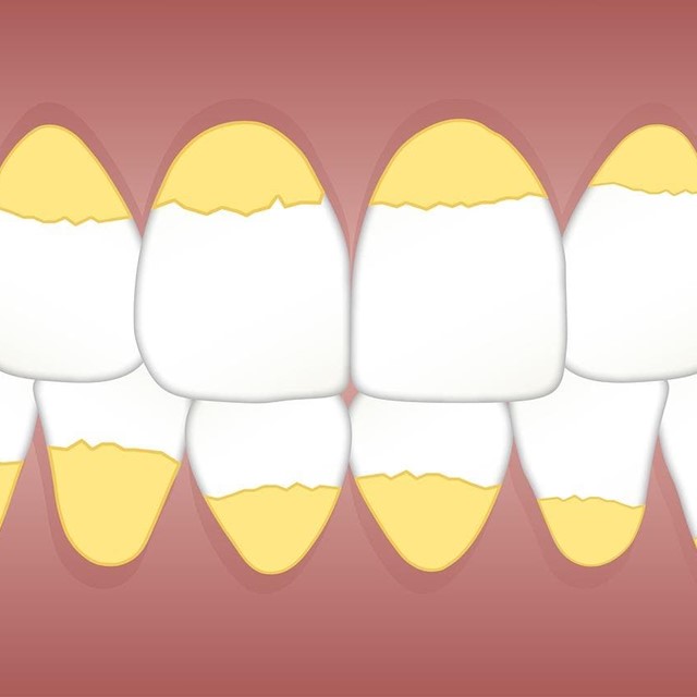 3 claves para evitar el sarro en los dientes