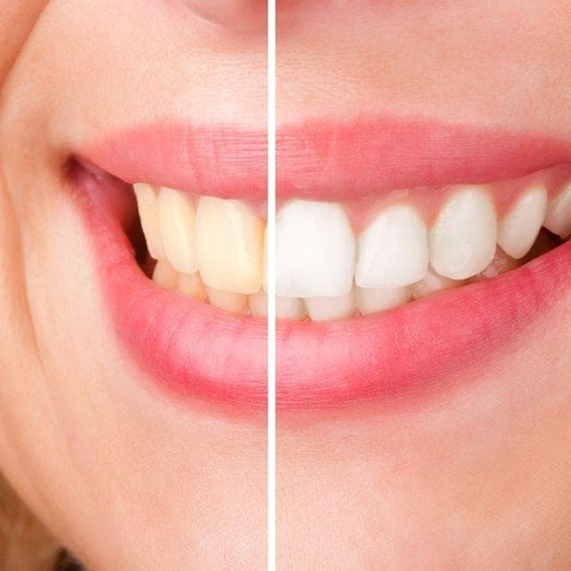 5 consejos para que el blanqueamiento dental dure más tiempo