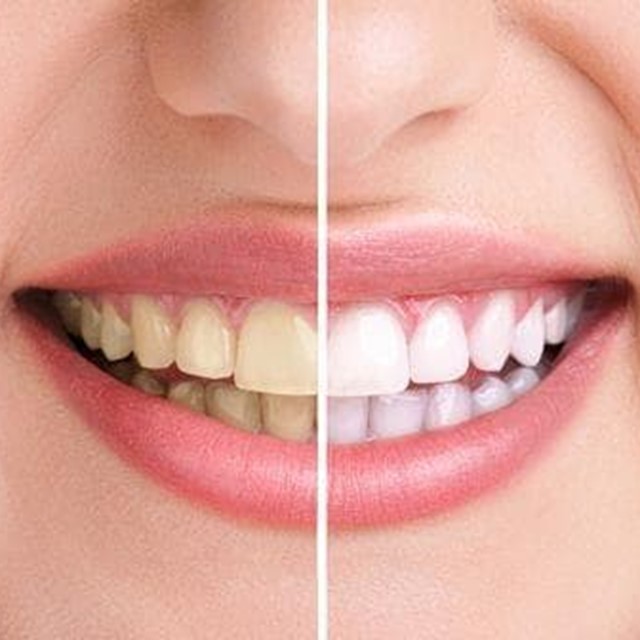 Blanqueamiento dental: todo lo que debes saber