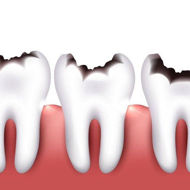 Caries dental: cómo afecta al resto de los órganos del CUERPO