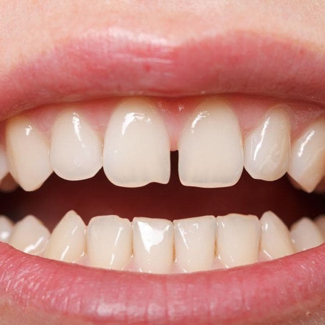 Diastema: qué es, causas y tratamientos