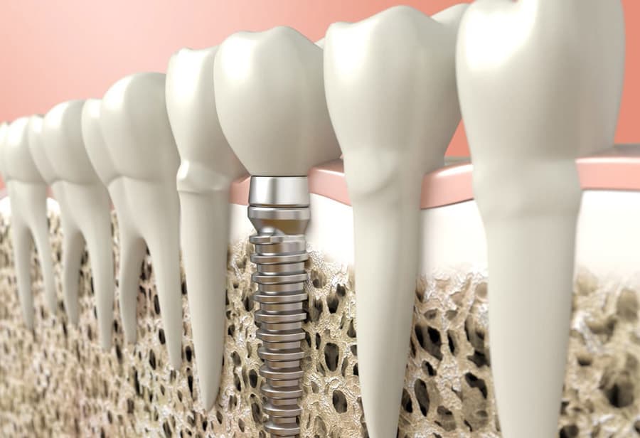 ¿Qué son los implantes dentales?