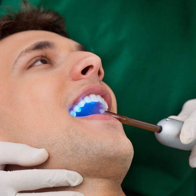 ¿Qué es un sellado dental y cuándo es necesario?