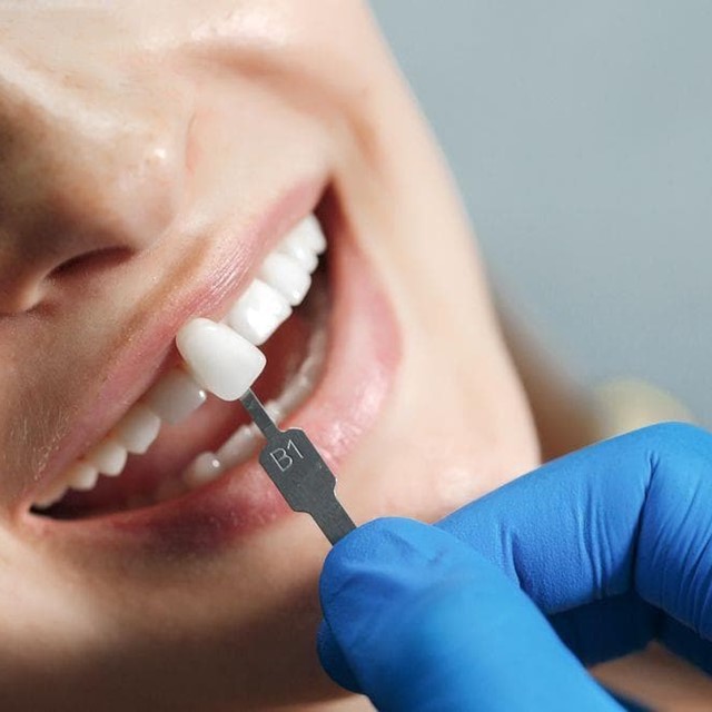 ¿Qué son los microimplantes dentales?