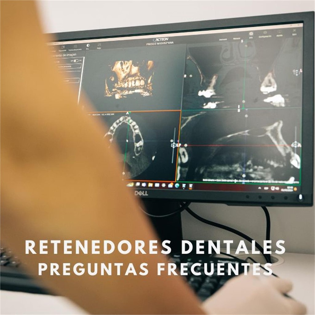 Retenedores Dentales: Preguntas más frecuentes sobre su funcionamiento y mantenimiento